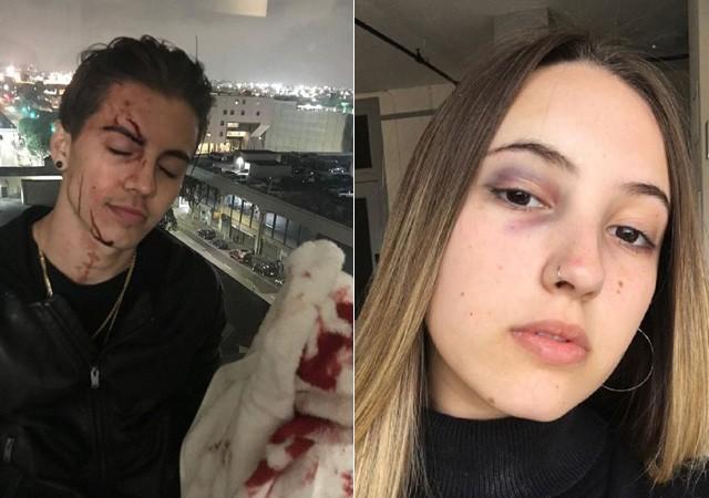 Biel e sua irmã Giovanna mostram hematomas (Crédito: Reprodução/Instagram)