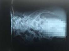 Homem coloca objeto inusitado no pênis e passar por cirurgia