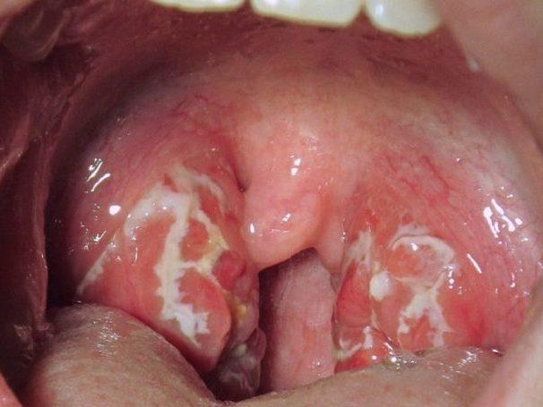 Dor de garganta: 10 remédios caseiros para curar a infecção