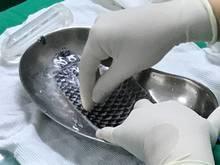 Reconstrução de vagina com uso de pele de peixe é tendência
