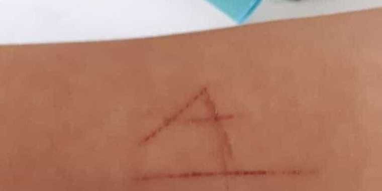 Estudante é dopada, estuprada e tem pulso marcado pela letra "A"