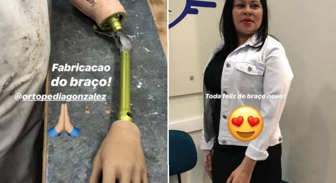 A prótese sendo feita e a mesma depois já colocada na professora (Crédito: Reprodução/Instagram)