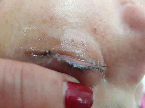 Mulher sofre por horas após colar cílios postiços com supercola