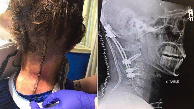 Brock Meister após cirurgia para reconstituição dos ligamentos do pescoço (Crédito: Divulgação/Beacon Health System)