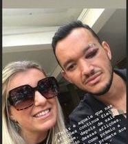 Mulher de Réver publica foto do zagueiro com olho inchado