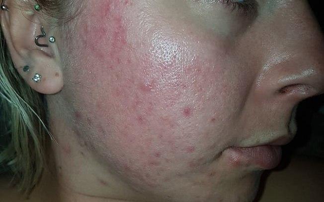 A britânica Emily McClarron que sofre de acne severa encontrou solução na "cápsula de maconha" (Crédito: Reprodução)