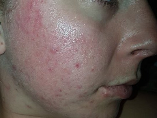 Jovem controla acne severa após usar cápsulas de maconha