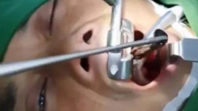 Médico retira sanguessuga que viveu por três meses na garganta de paciente