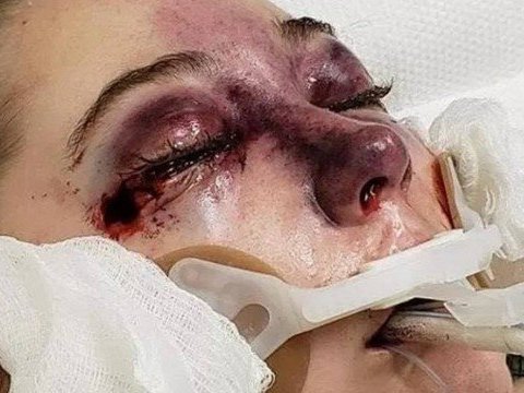 Adolescente "chora sangue" após contrair doença durante cruzeiro