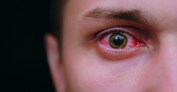 Síndrome do olho vermelho cresce e pode virar doença mais grave - Sintomas - meionorte.com