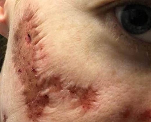 Mulher contrai bactéria "zumbi" após lavar rosto em banheiro público