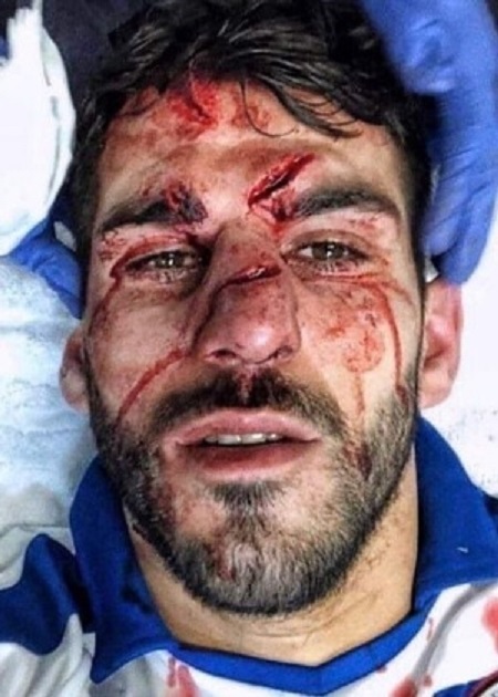 Jogador português sofre pisão no rosto e passa por cirurgia
