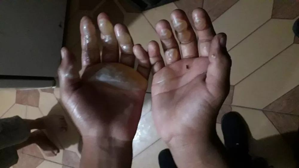 Mãe será indiciada após queimar mãos do filho com ferro de passar