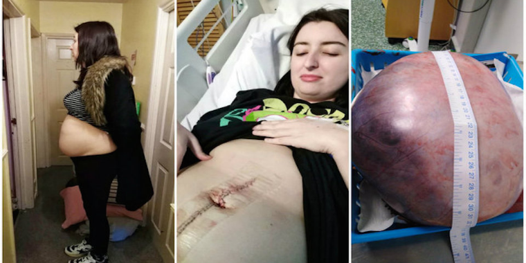 Mulher pensa estar grávida, mas descobre tumor igual melancia