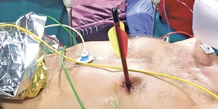 Homem sobrevive após ser flechado no coração e pulmão