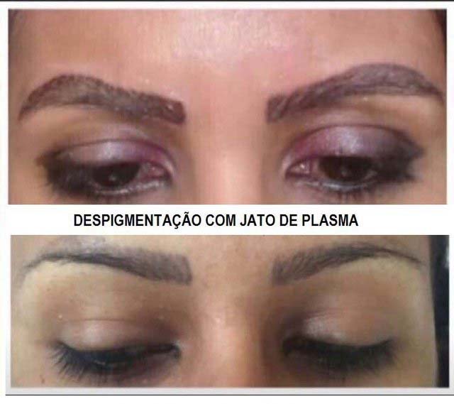 Quadro Beleza e Saúde fala sobre Jato de Plasma