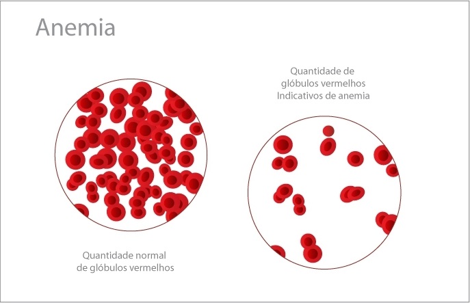 Sintomas De Anemia Quais São Como Saber Se Você Está Anêmico