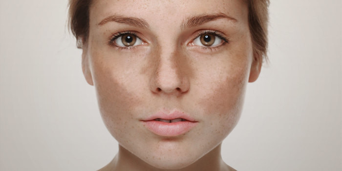 Dermatologista fala sobre melasma