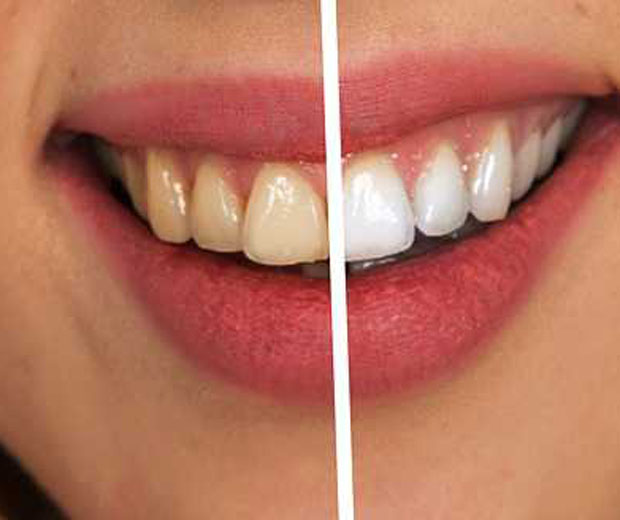 Os benefícios da lente de contato dental