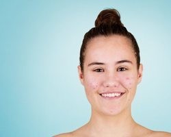 Cresce o número de casos de mulheres adultas com acne