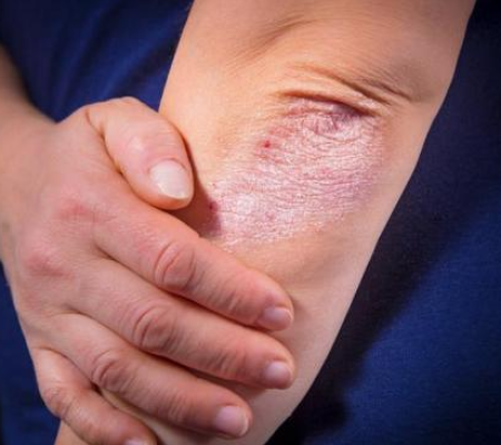 Dermatologista dá dicas para evitar ressecamento da pele no verão