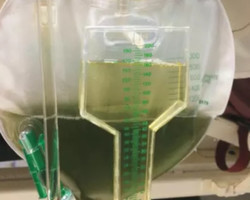 Urina verde: caso assusta paciente com doença pulmonar 