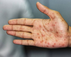 Sesapi prepara ações de combate à sífilis em todo o estado