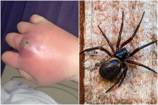 Mulher foi  picada por uma aranha viúva falsa