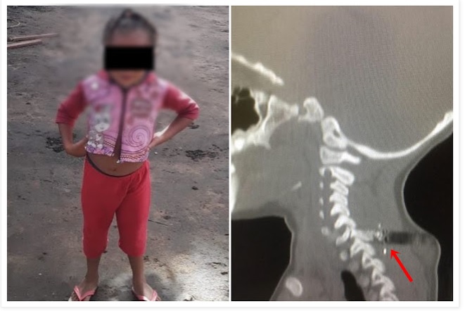 Menina de 4 anos foi baleada em troca de tiros entre bandidos