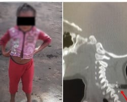 Criança é baleada em tiroteio em Codó e pode ficar paraplégica 