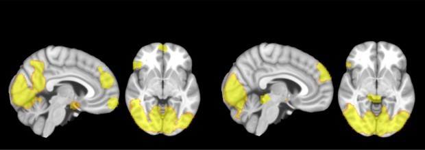 Estudos no cérebro prodem ajudar a reduzir a violência doméstica e identificar possíveis agressores