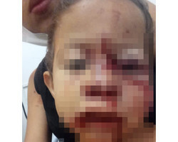 Criança tem o rosto desfigurado após ser atacada por cachorro no Piauí