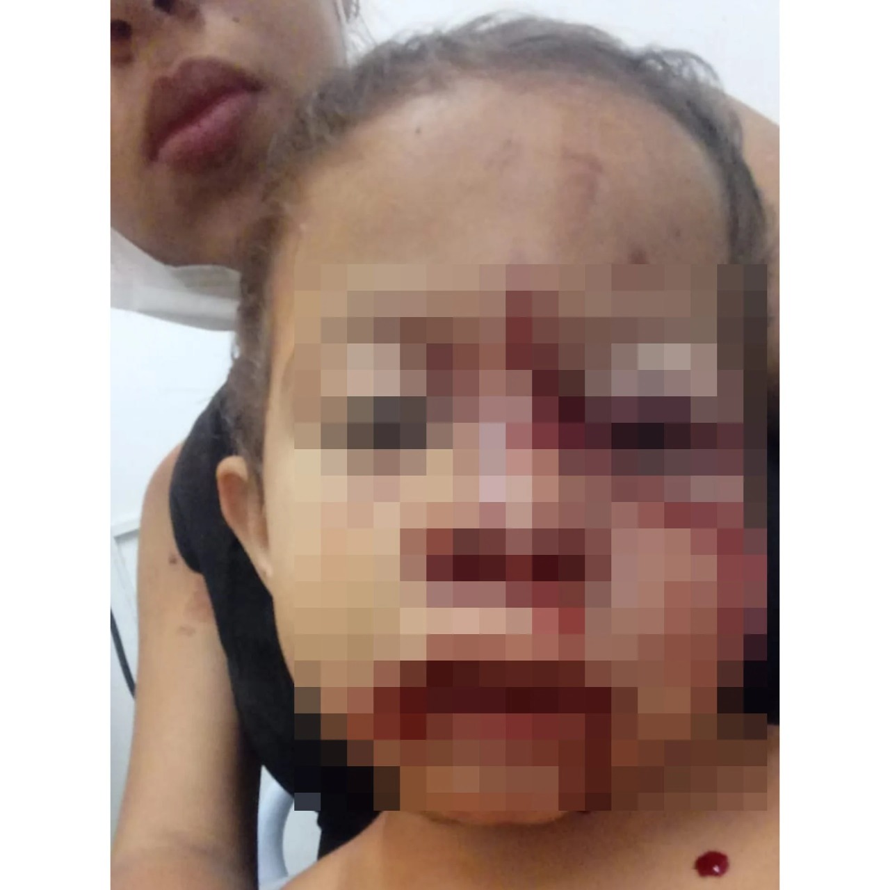 Criança ficou com o rosto desfigurado após ser atacada por cachorro (Foto: Reprodução)