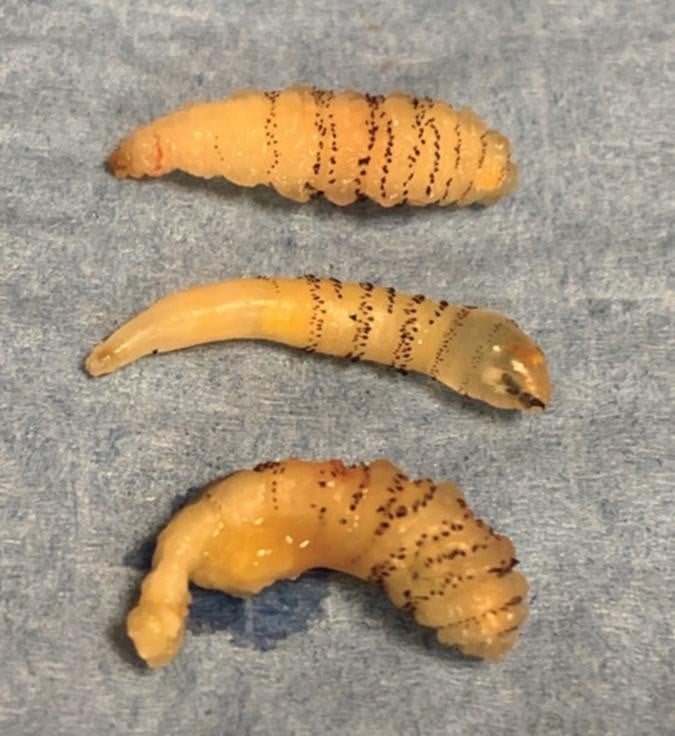 Larvas que foram encontradas em mulher. (Foto: New England Journal of Medicine)