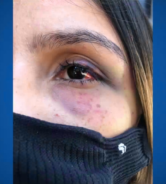 Vítima ficou com vários hematomas pelo corpo após a agressão do ex-companheiro - Foto: Reprodução
