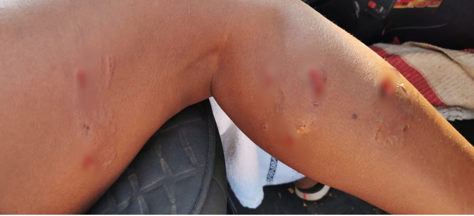 Moradora foi atacada e ficou com diversas mordidas pela perna 