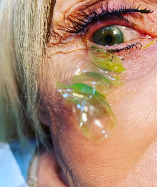 Mulher esquecia de retirar as lentes de contato a noite - Foto: Katerina Kurteeva