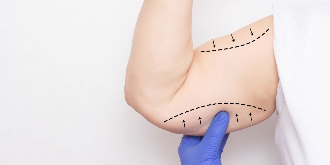 Braquioplastia: cirurgia é indicada para quem tem excesso de pele nos braços 