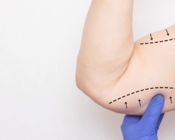 Braquioplastia, a cirurgia que acaba com o excesso de pele nos braços