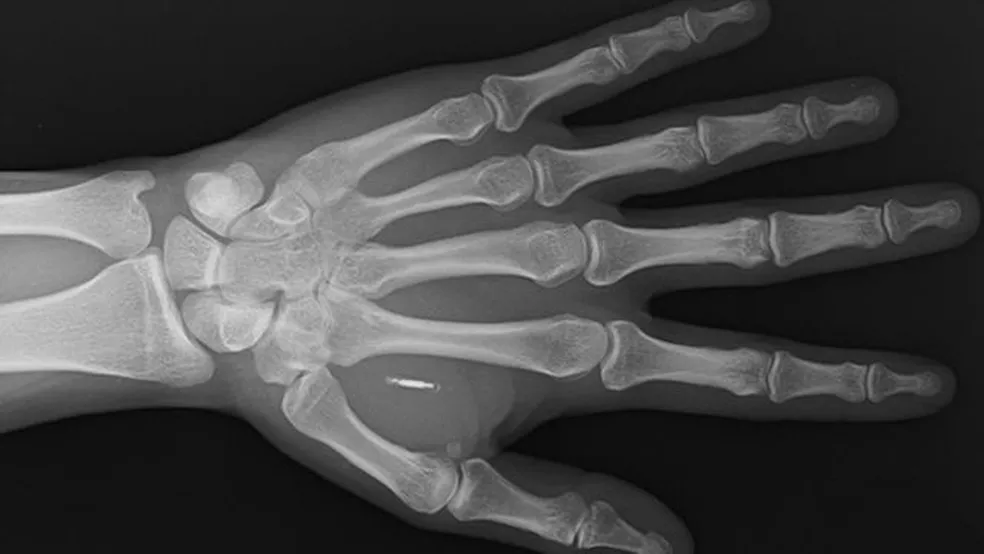 Um raio-x mostrando um implante Walletmor, que é injetado na mão de uma pessoa após um anestésico local — Foto: WALLETMOR 