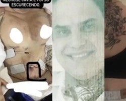 Mulheres que tiveram sequelas após plásticas denunciam médico no Ceará
