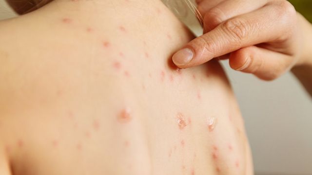 Sesapi investiga oito casos suspeitos de sarampo no Estado (Foto: Divulgação/Getty Images)