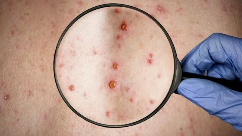 Ministério da Saúde confirma terceiro caso de varíola dos macacos (Foto: Divulgação)