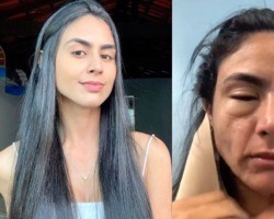 Estudante fica com o rosto deformado após comer camarão em quiosque no Rio