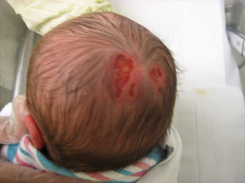 Skin Abnormalities In Newborns