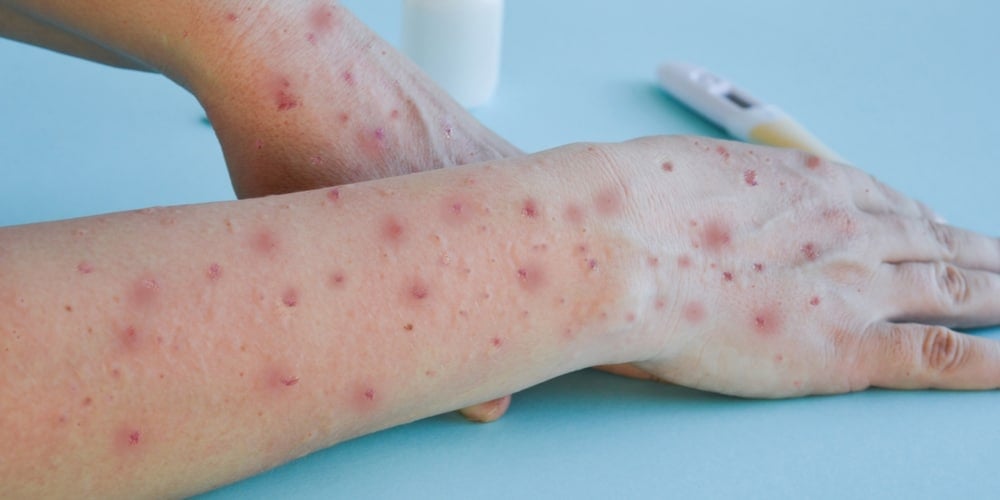 Os sintomas iniciais da varíola costumam surgir dentro de 1 a 3 dias (Foto: reprodução)