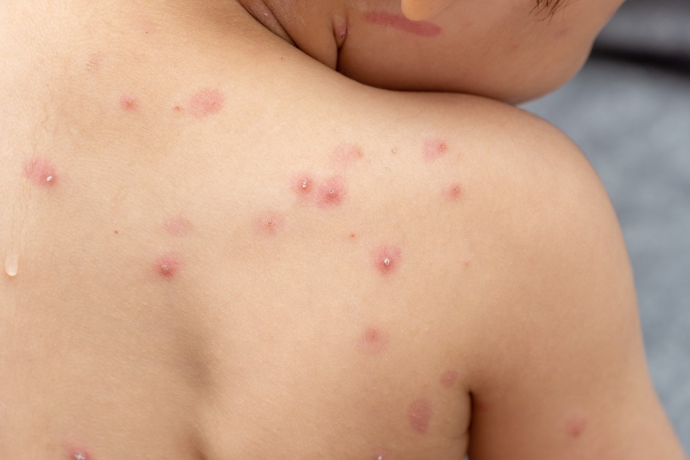 Brasil tem 21 casos confirmados de varíola dos macacos Foto: Reprodução