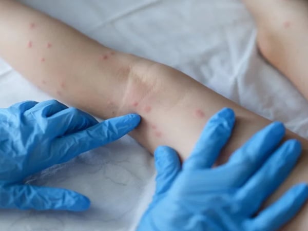 “Situação no Brasil é preocupante”, afirma OMS sobre varíola dos macacos
