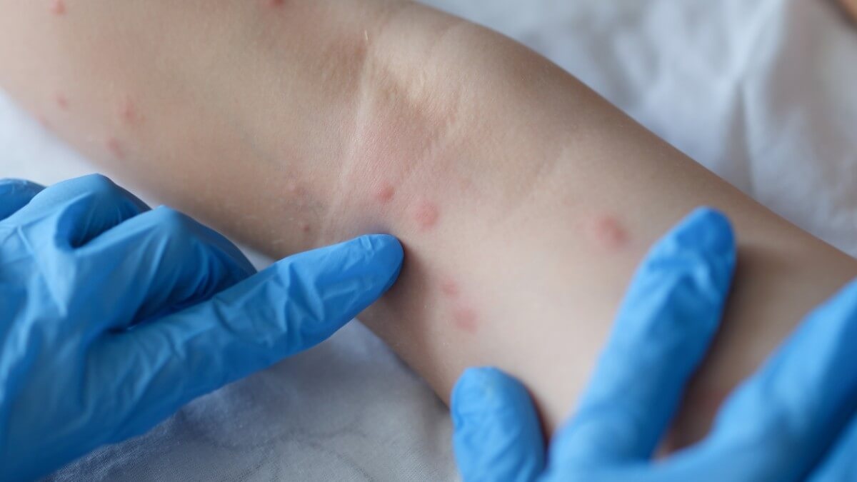 Doença causa erupções na pele | FOTO: Shutterstock