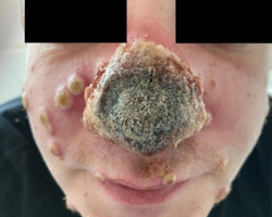 Homem fica com nariz necrosado após descobrir varíola dos macacos e HIV 
